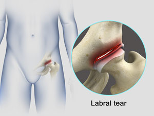 Hip Labral Tear