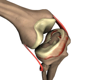 Meniscal Surgery