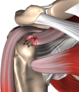 Rotator Cuff Tear