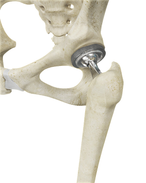  Hip Joint Replacement
