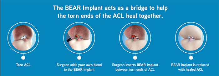 Bear Implant