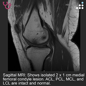 Isolated Medial Femoral Condyle Lesiont