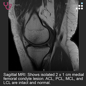Isolated Medial Femoral Condyle Lesiont