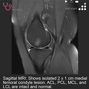 Isolated Medial Femoral Condyle Lesiont