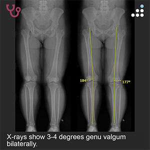 Isolated Medial Femoral Condyle Lesiont