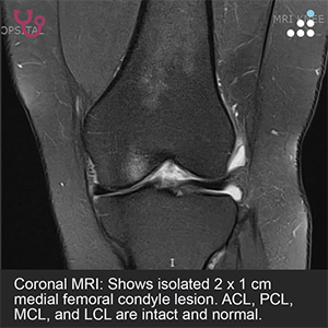 Isolated Medial Femoral Condyle Lesiont