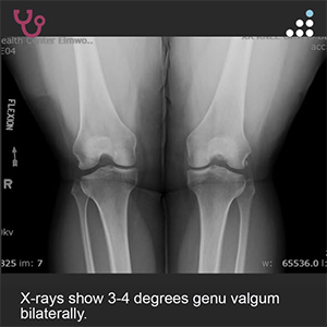 Isolated Medial Femoral Condyle Lesiont