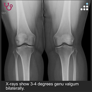 Isolated Medial Femoral Condyle Lesiont