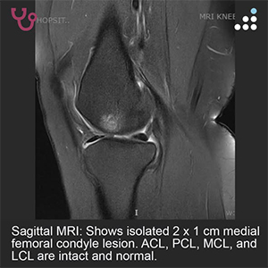Isolated Medial Femoral Condyle Lesiont