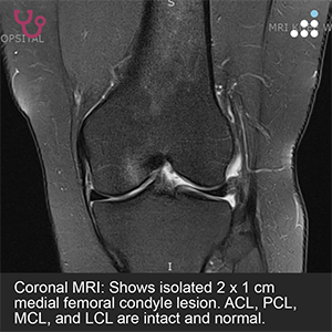 Isolated Medial Femoral Condyle Lesiont